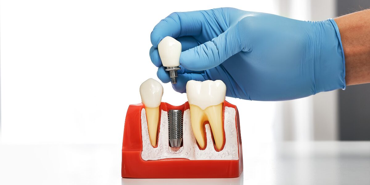 dental implants