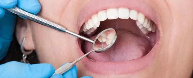 Wisdom Teeth Removal vs Tooth Extraction in Woodbridge, VA